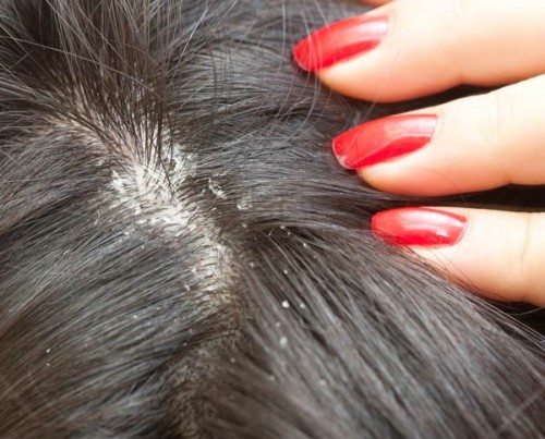 Home Remedies to get rid of Dandruff