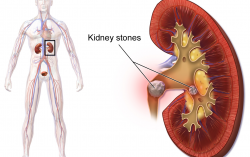 What Causes Kidney Stones