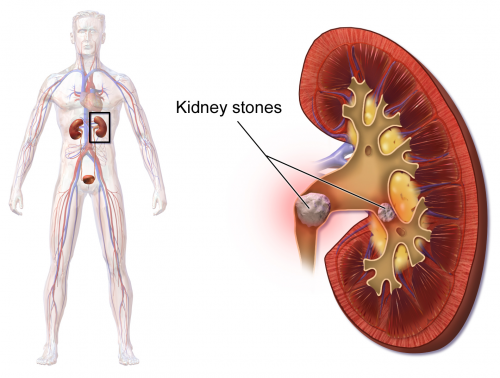 What are kidney stones