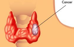 Thyroid Cancer: Use Thyroid Guard when you go for Dental X-ray or Mammogram