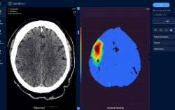 Kazakhstan Startup CerebraAI Relocates Headquarters to Silicon Valley to Address Severe Emergency Care Diagnostics Gap through Novel Generative AI Medical Imaging Approach